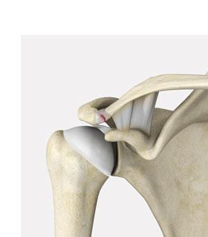 ac-joint-separation-type