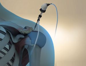 benefits-of-arthroscopic-surgery