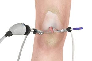 diagnostic-arthroscopy