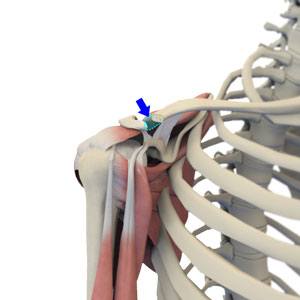 Proximal Biceps Tenodesis