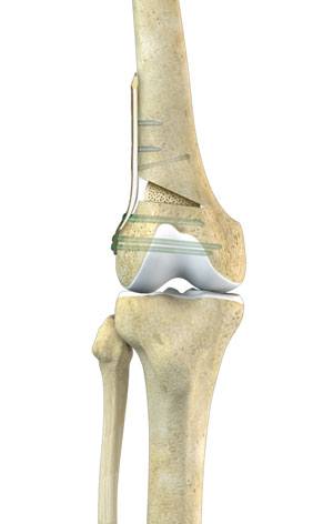 Distal Femoral Osteotomy