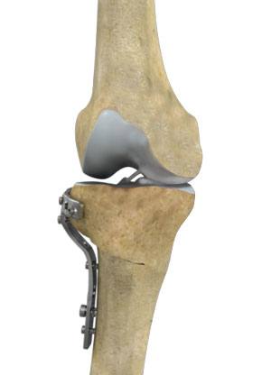 High Tibial Osteotomy