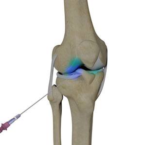intraarticluar-knee-injection
