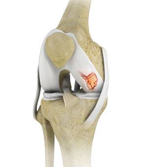 Knee Cartilage Restoration