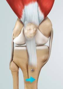 knee-osteotomy
