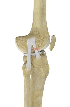 knee-sprain