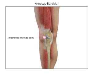 kneecap-bursitis