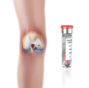 matrix-induced-autologous-chondrocyte-implantation