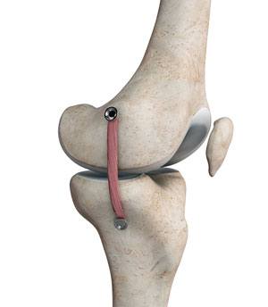 MCL Reconstruction