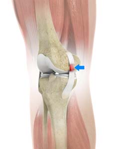 mcl-sprain