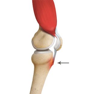 osgood-schlatter-disease