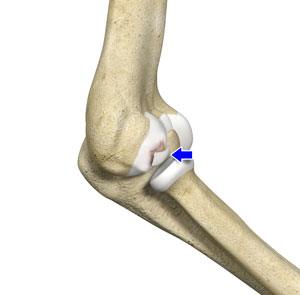 Osteochondritis Dissecans of the Knee