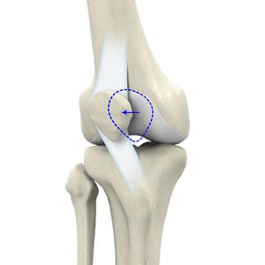 Patellar Instability