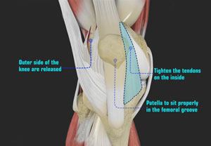 patellofemoral-realignment