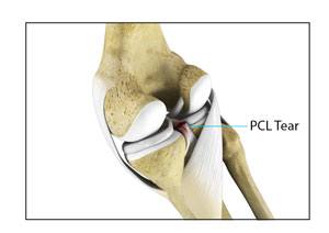 pcl-injuries