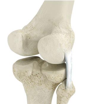 posterolateral-corner-reconstruction