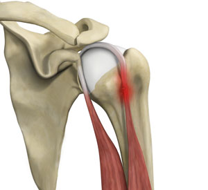 proximal-biceps-tendinitis