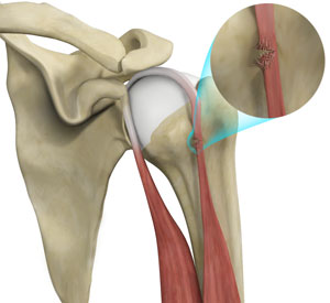 proximal-biceps-tendon-rupture