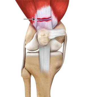 quadriceps-tendon-rupture