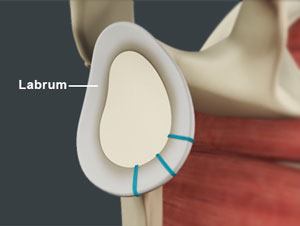 Shoulder Labrum Reconstruction