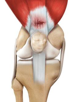 tendon-injuries