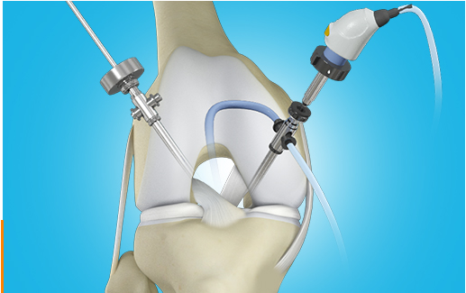 Arthroscopic Techniques